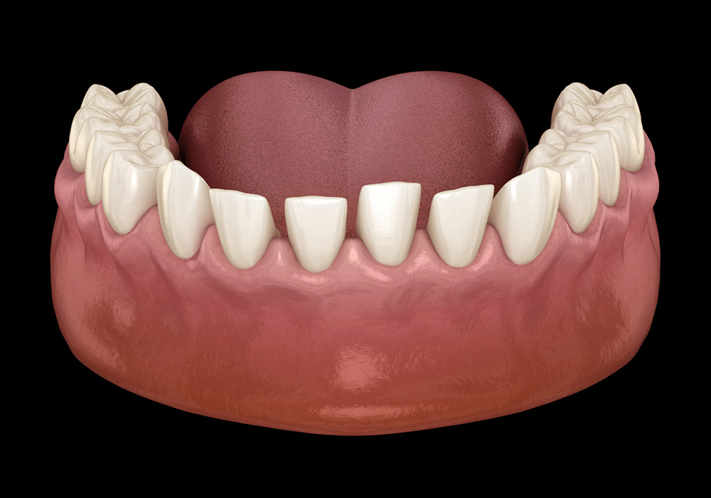 3D illustration of a lower jaw showing teeth with varying degrees of spacing issues, highlighting orthodontic concerns and the anatomical details of the teeth and gums, set against a dark background.